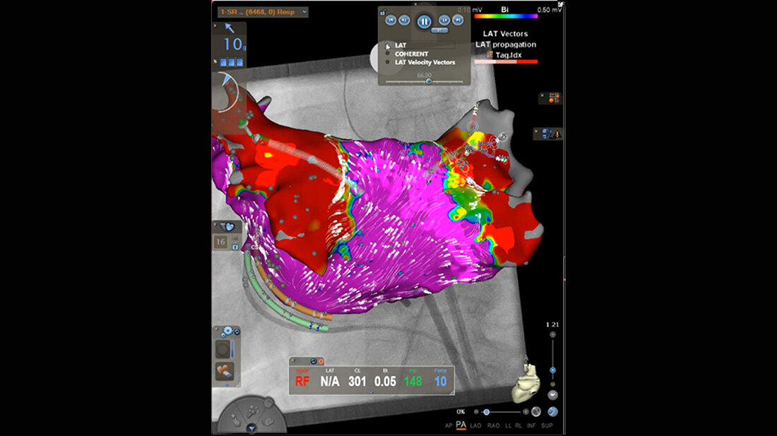 Linker Vorhof 3D-mapping
