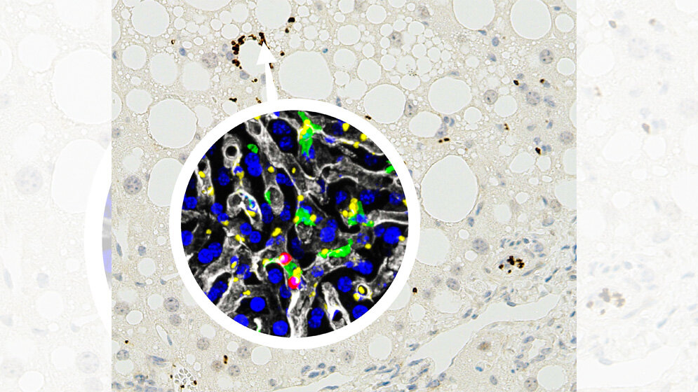 Mausleber mit nicht alkoholischer Steatohepatitis 