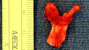 Osteochondrom