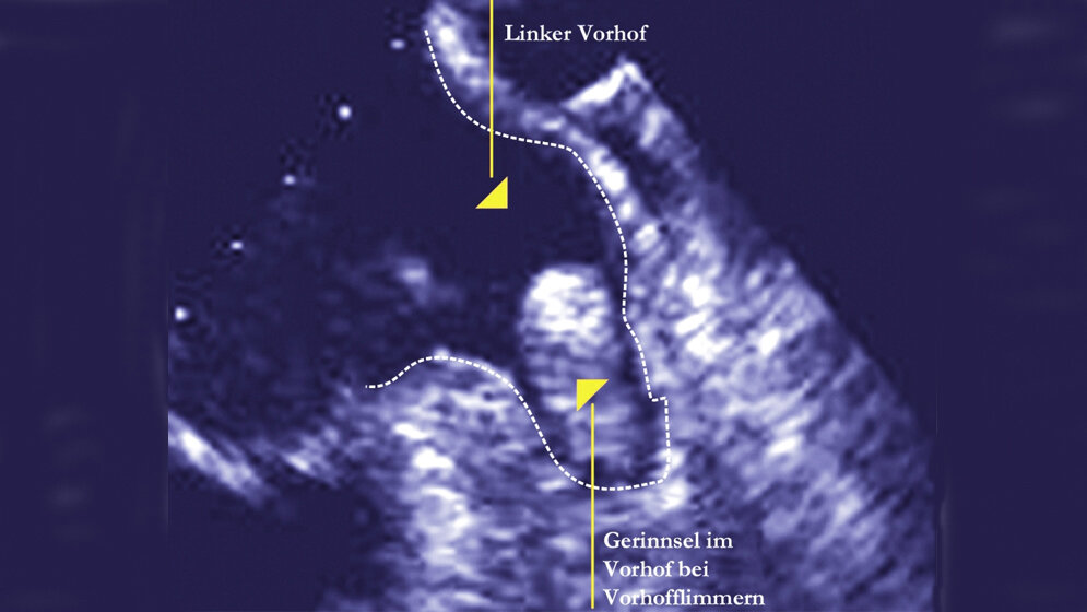Gerinnsel im linken Vorhofohr