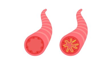 Bronchien_Asthma.jpg Bronchienverengung