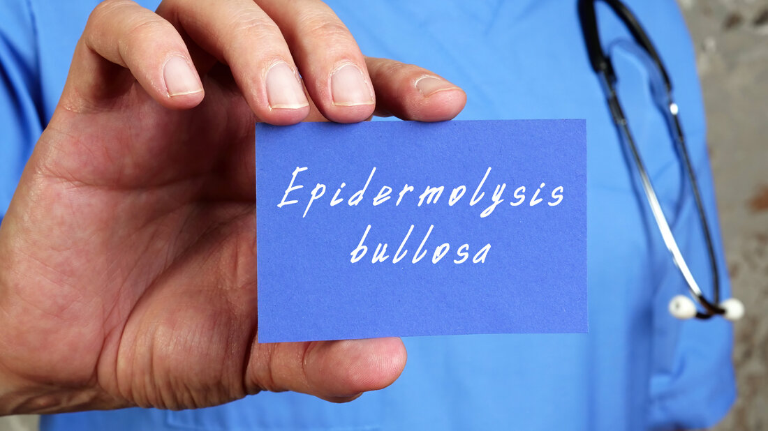 Epidermolysis_bullosa_stock_adobe_com_1100.jpg Epidermolysis bullosa