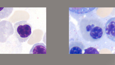 Dysplastische Veränderungen der Hämatopoese (Teil 3)