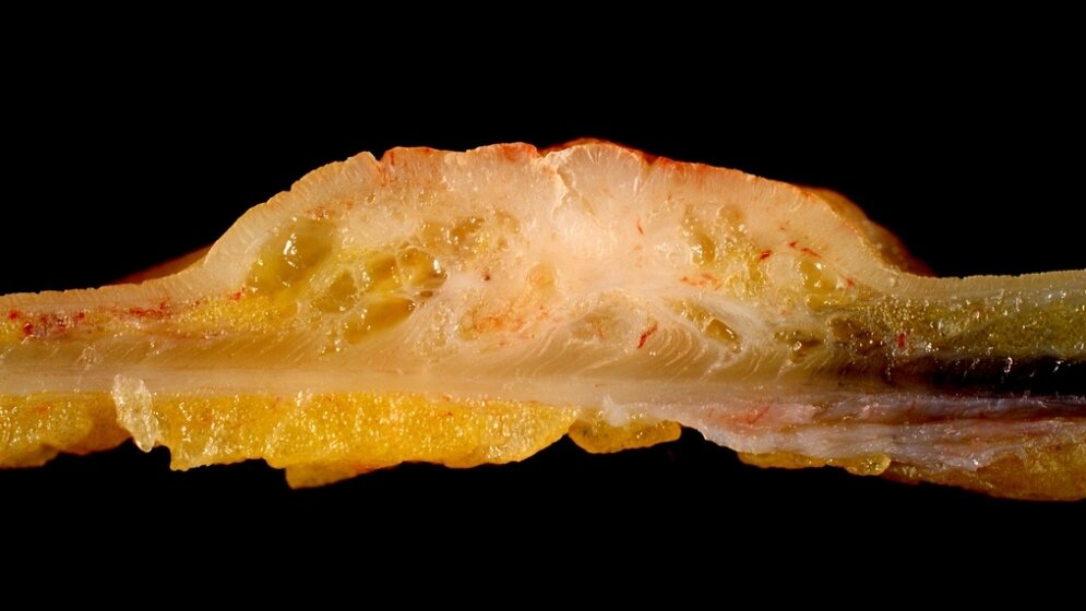 Adenokarzinom Sigmoid