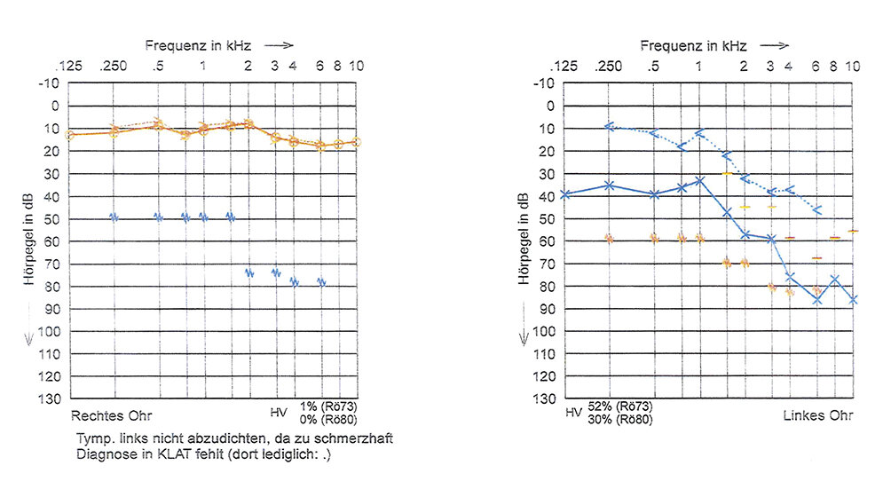 Komplikation einer Mittelohrentzündung: Hirnabszess