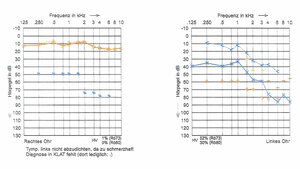 Komplikation einer Mittelohrentzündung: Hirnabszess