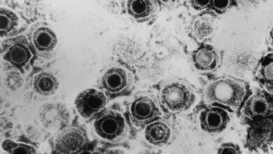 Herpes simplex Virus