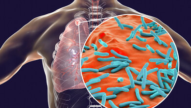 TB_Adobe.jpg Blutbasierte Biomarker bei TB