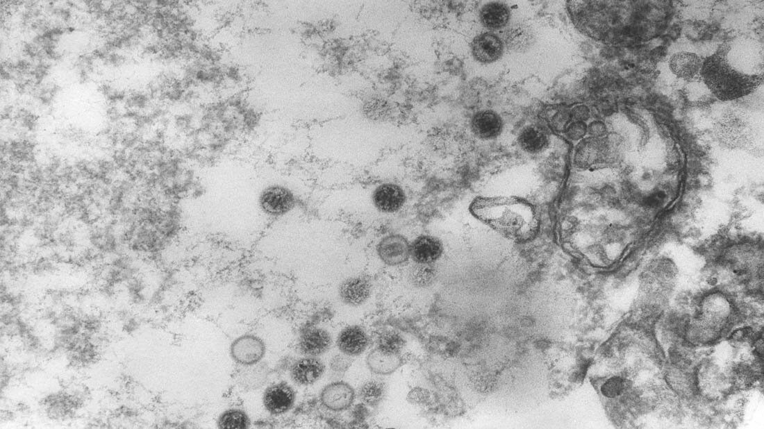 Der britische Virologe Anthony Epstein (1921–2024) Zahlreiche Virionen des Epstein-Barr-Virus (EBV), TEM