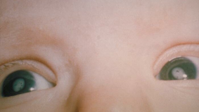 Cataracts_.jpg Röteln