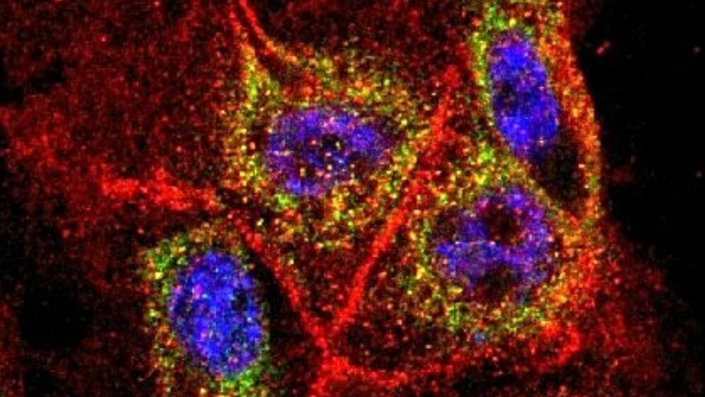 Krebszellen aus der Bauchspeicheldrüse