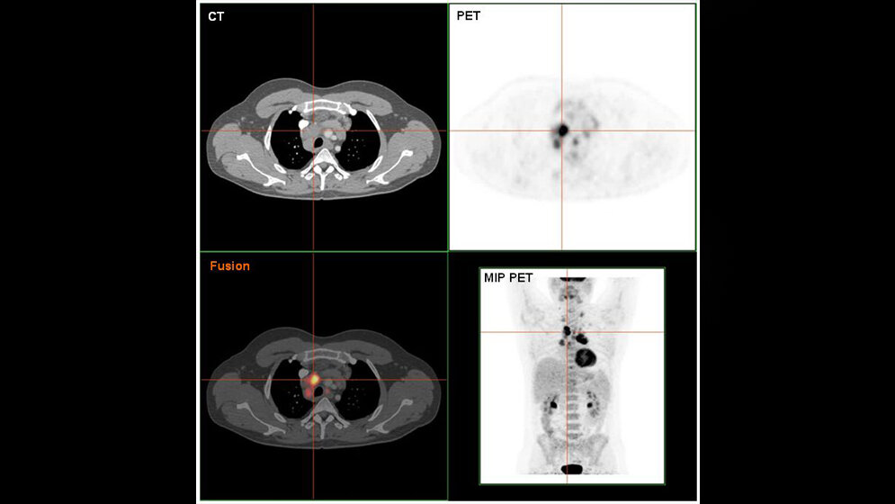 PET/CT-Aufnahme