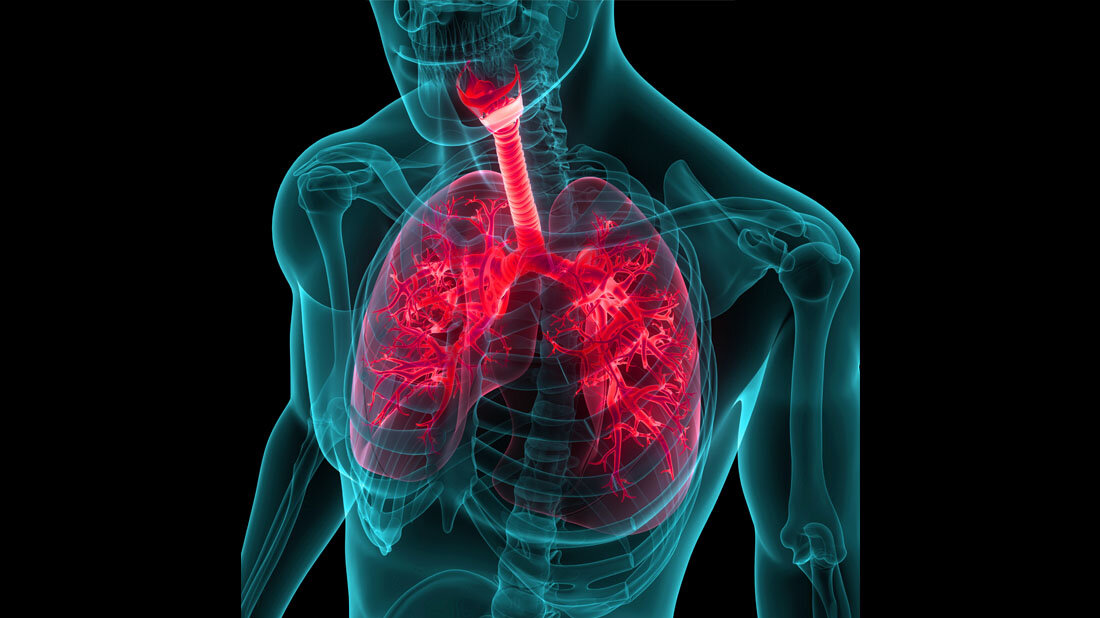 Pneumonie
