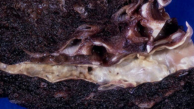 Lungenarterie Atherosklerose