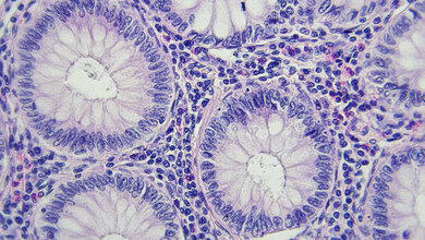 Darmkrebs_Pathologie.jpg Gewebeschnitt von Darmkrebszellen