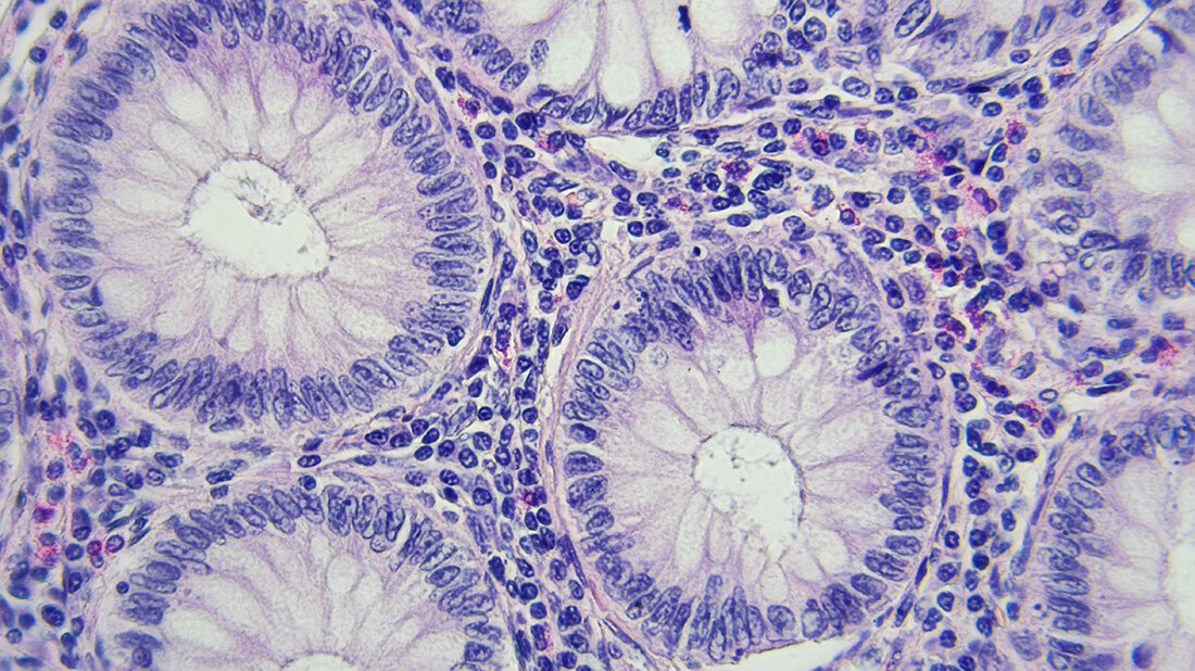 Darmkrebs_Pathologie.jpg Gewebeschnitt von Darmkrebszellen