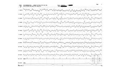 Neurologie Hepatische Enzephalopathie im EEG
