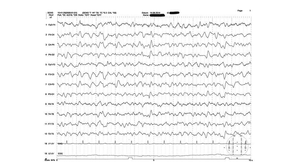 Hepatische Enzephalopathie im EEG