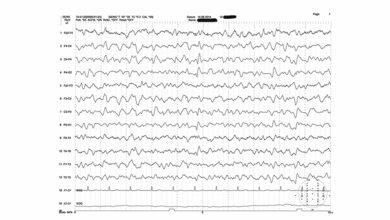 Neurologie Hepatische Enzephalopathie im EEG