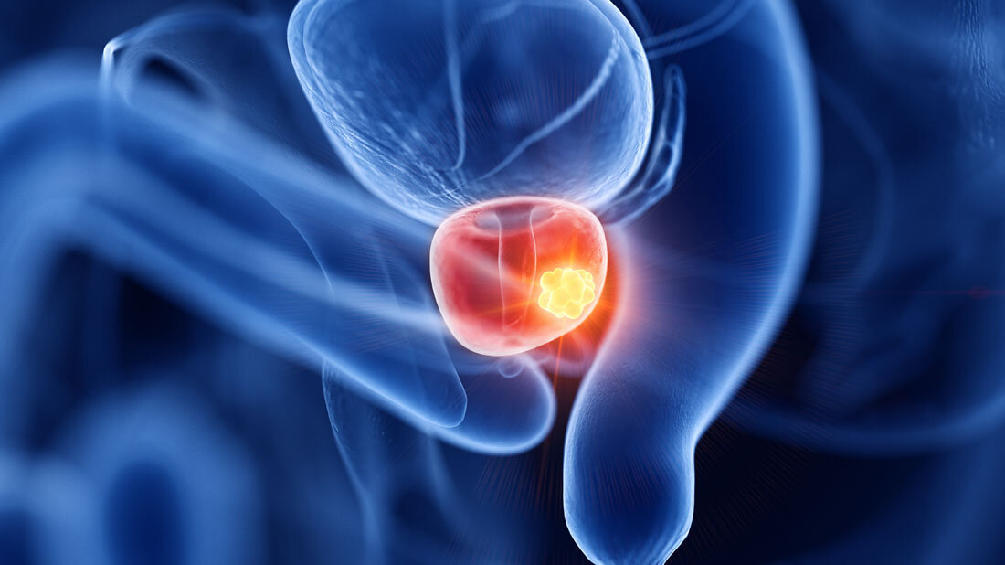 Prostatakrebs.jpg Darstellung von Prostatakrebs