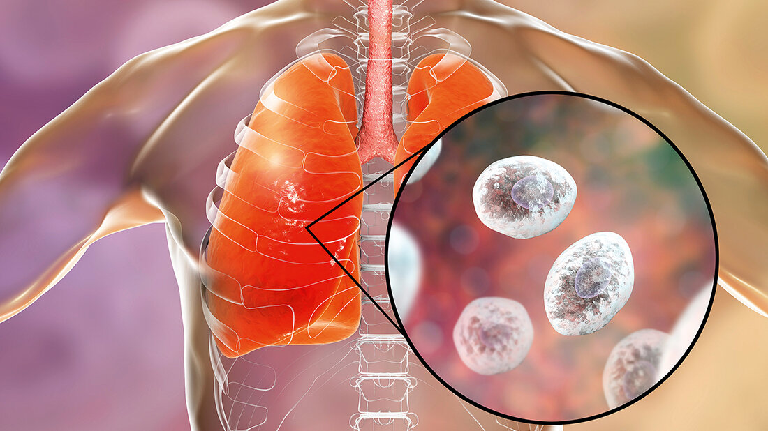 Missbrauch von Antibiotika, oder nicht? Grafik mit vergrößerter Darstellung von Pneumocystis jirovecii in der Lunge