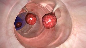 Colonoscopy and Enteroscopy