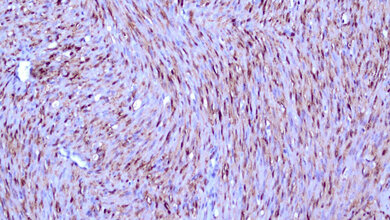Klassisches mesoblastisches Nephrom 