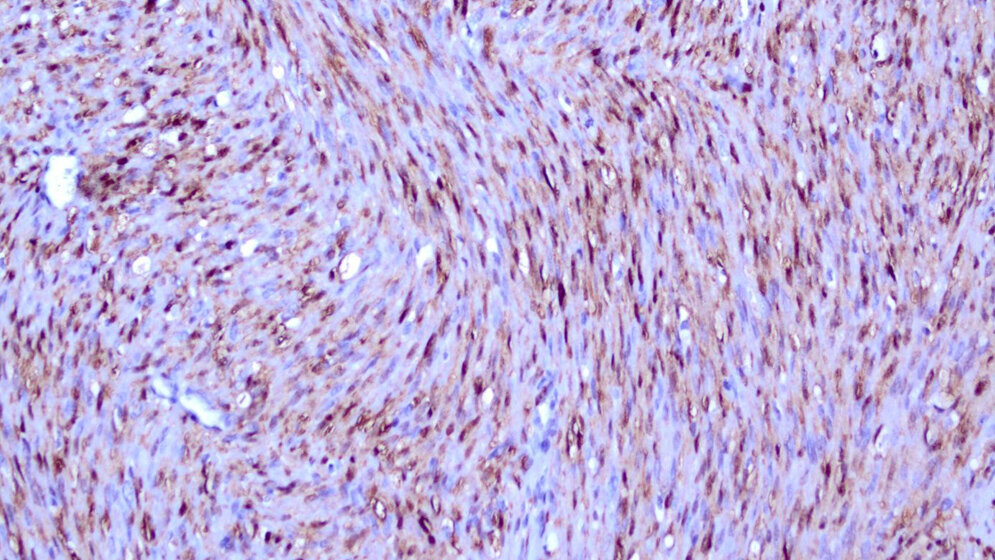 Klassisches mesoblastisches Nephrom 