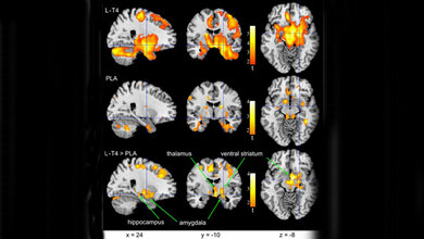 Gehirn-Bereiche, in denen sich die relative Aktivität änderte 