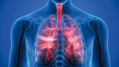 Sonstiges Asthma oder COPD – ACO(S)