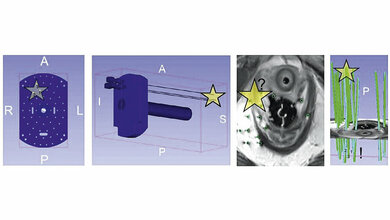 Aus der Forschung Brachytherapie