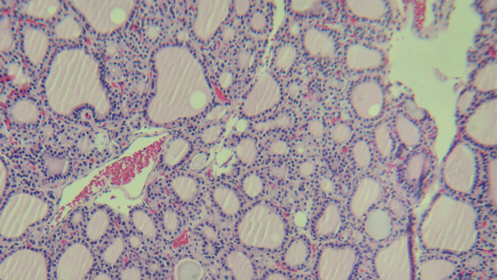 Autoimmunerkrankungen: Die Schilddrüse