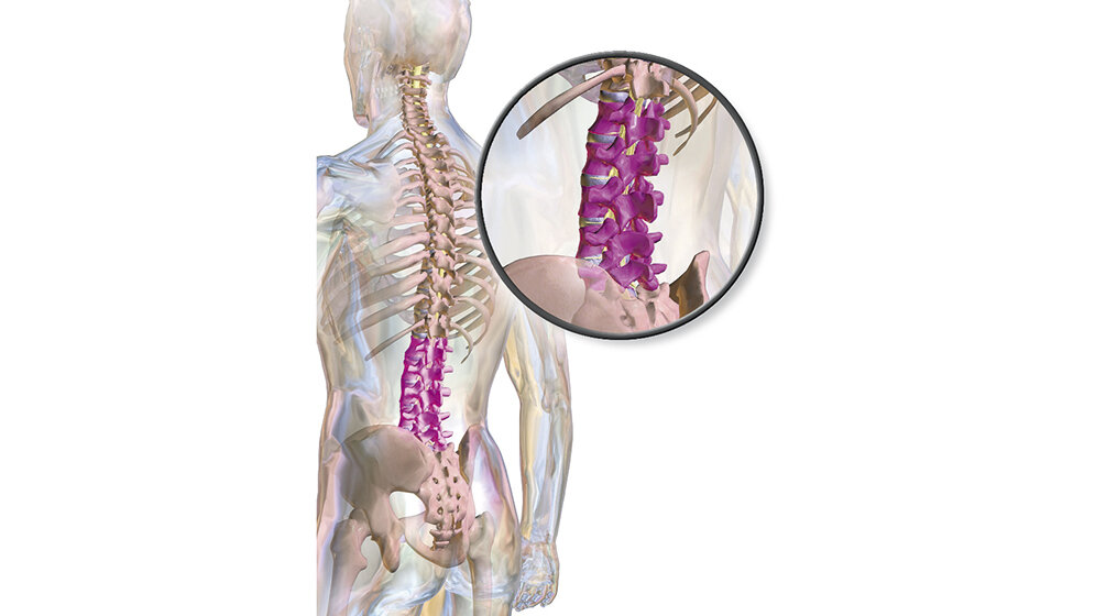Spinale Malformationen: Lumbosakrale Übergangsvariante