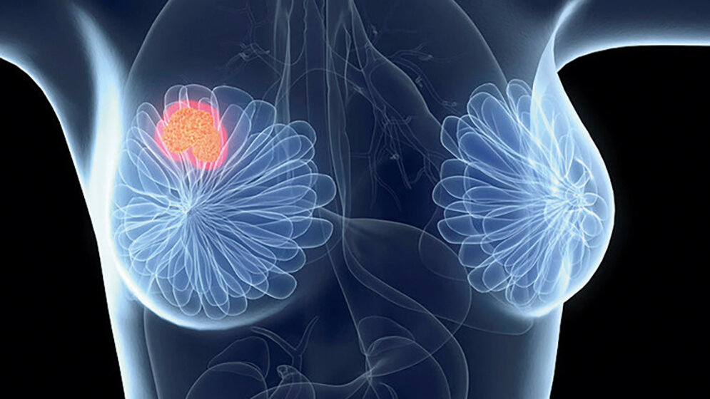 Überdiagnose in  der Früherkennung