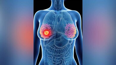 Palbociclib-Kombination bei fortgeschrittenem Brustkrebs