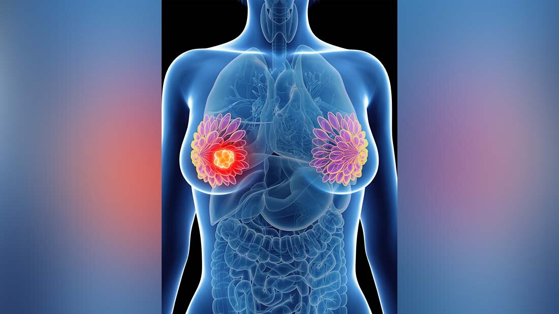 Palbociclib-Kombination bei fortgeschrittenem Brustkrebs