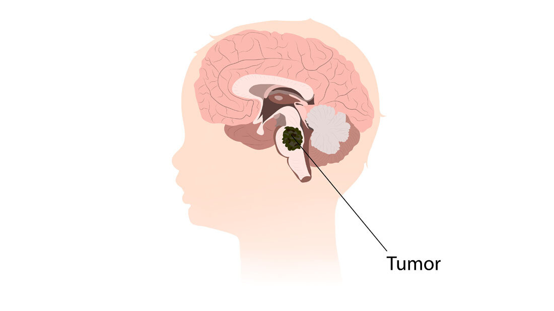 Gliom_am_Hirnstamm.jpg Gliom am Hirnstamm