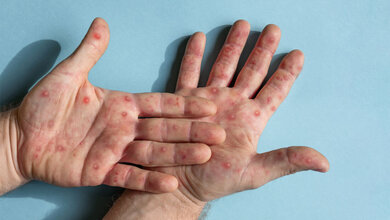 mpox.jpg Mpox