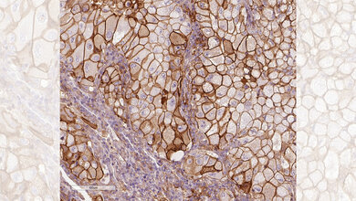 Getarnte Krebszellen