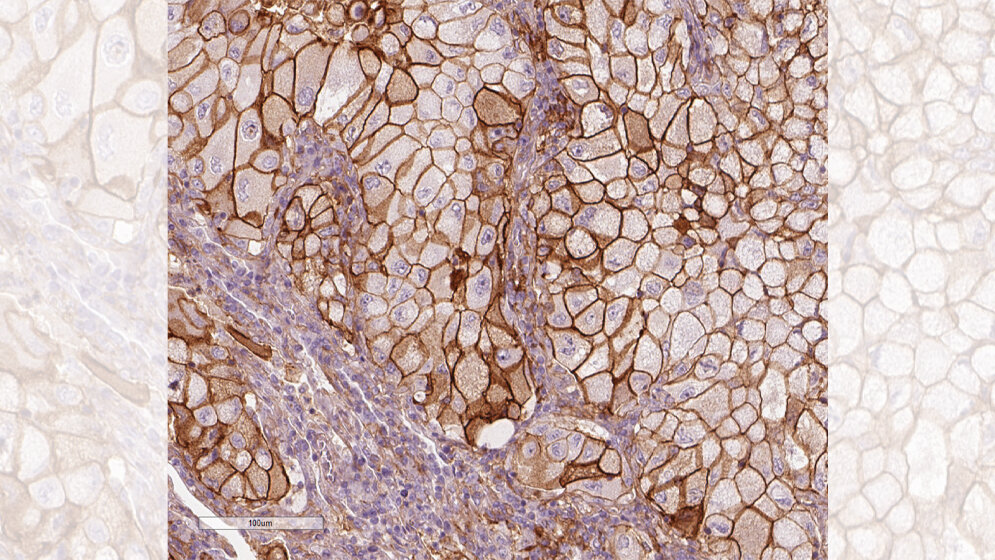 Getarnte Krebszellen