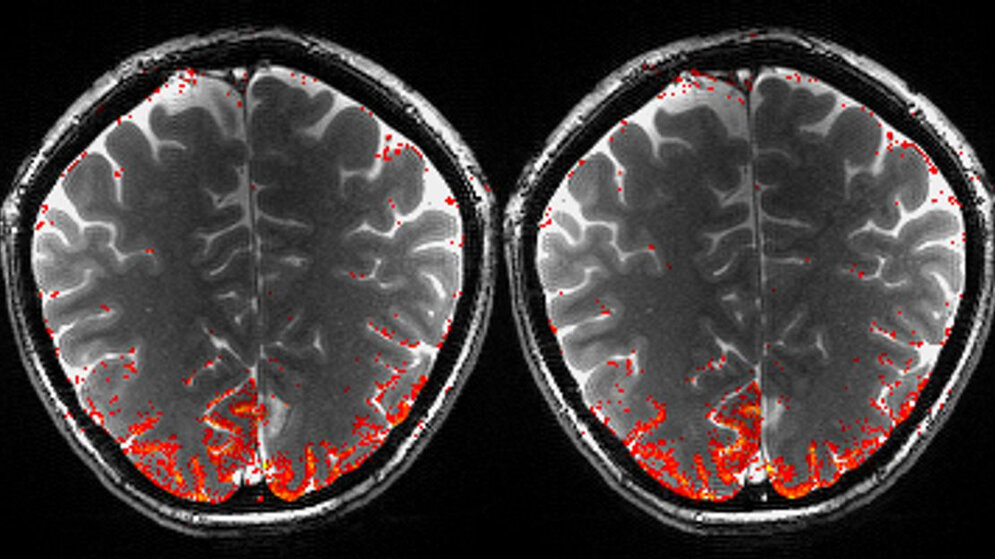 Aktivierung des visuellen Kortex 