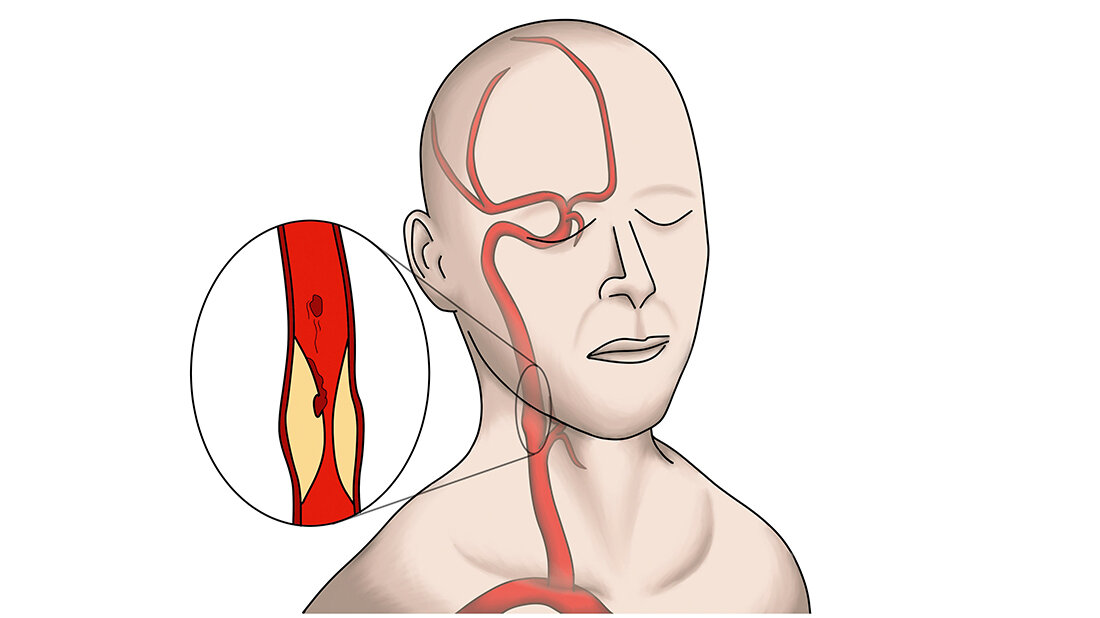 Grafische Darstellung einer Stenose der Arteria carotis interna