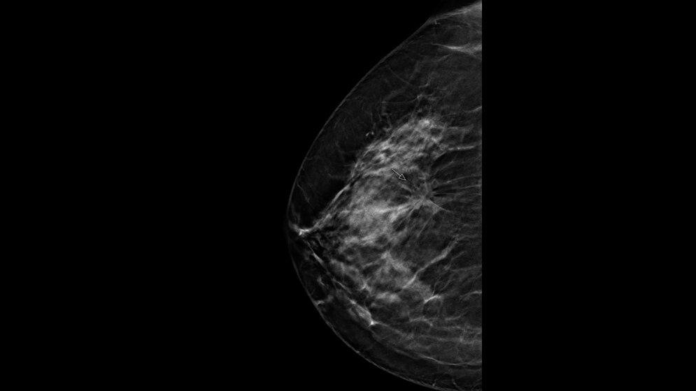 Digitale Tomosynthese der Brust