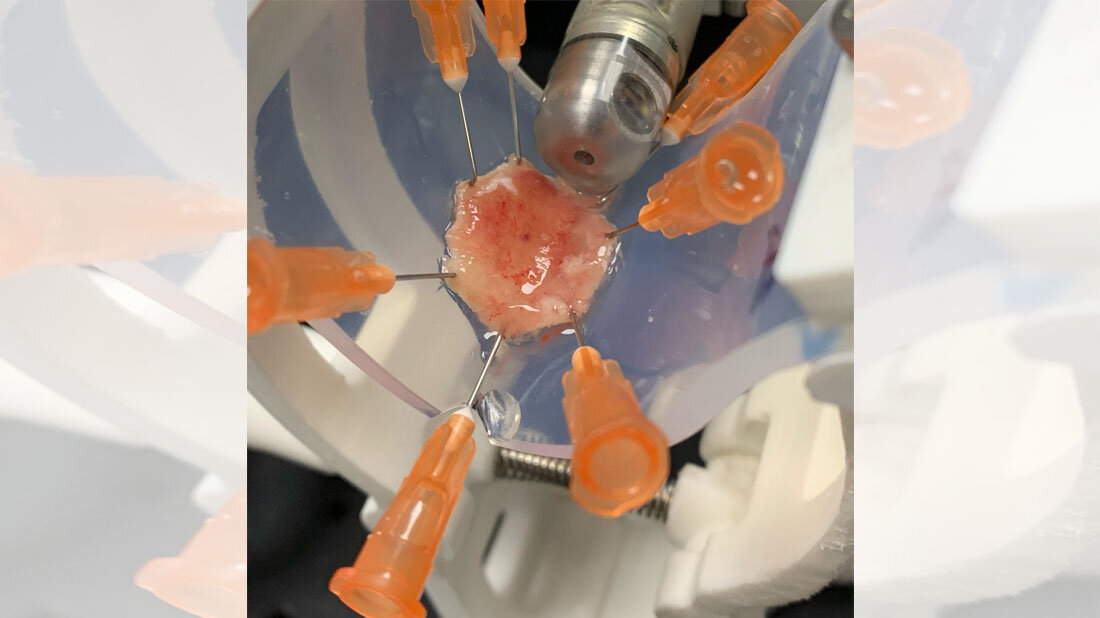 Speiseröhrenkrebs frühzeitiger erkennen Eine neu entwickelte Endoskopie-Kapsel, die das Gewebe in einem vollständigen 360-Grad-Winkel scannt.