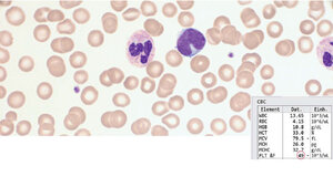  Immunthrombopenie bei einer Schwangeren
