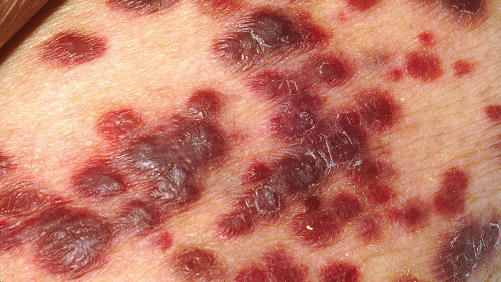 Das erworbene Immunmangelsyndrom (Teil 2)