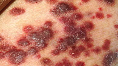 Das erworbene Immunmangelsyndrom (Teil 2)