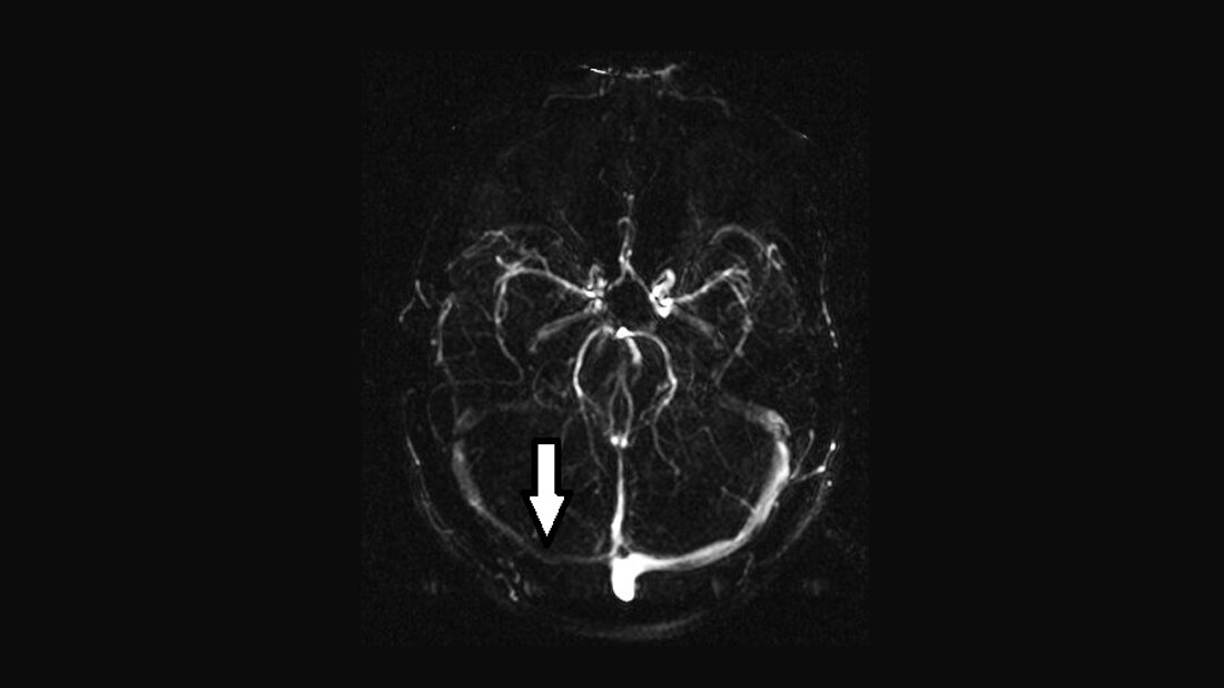 Anomalien und Normvarianten –
kranielle Veränderungen 1.13:
Asymmetrie des Sinus transversus PC-MR-Angiografie: Hypoplasie des Sinus sagittalis inferior und des Sinus transversus rechts (Pfeil) im Rahmen der Varianz