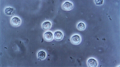 Anzeichen für eine Infektion der Harnwege