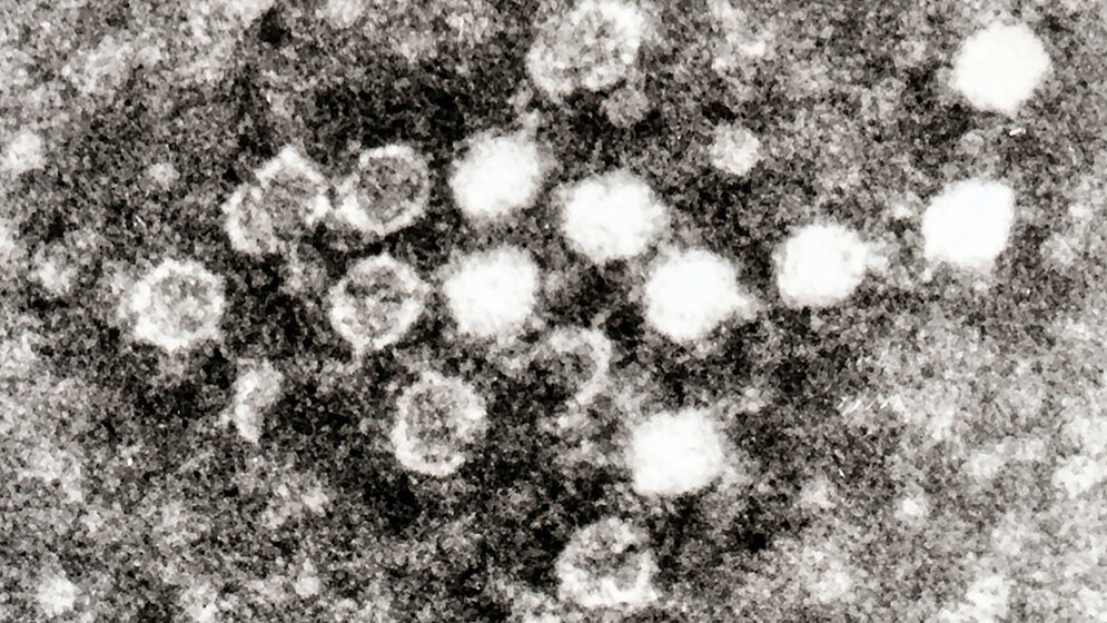 Zytomegalievirus und Parvovirus B19 (2)